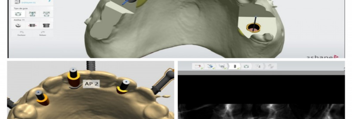 Cirurgia guiada - Implante Dentário sem corte e sem dor.  Dentista SJC