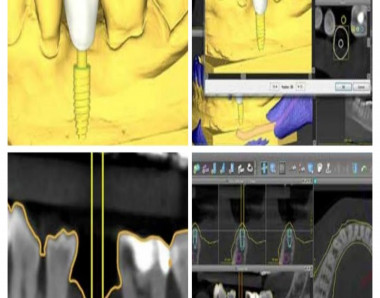 Cirurgia Guiada de implantes dentários