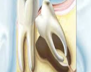 DENTE DO SISO - Dentista SJC - Especialista em extração siso