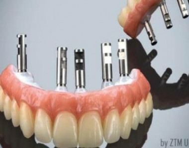 IMPLANTES DENTÁRIOS - DENTISTA - SJC