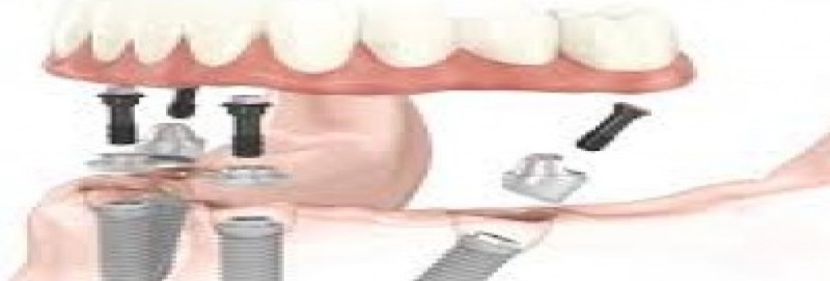 PASSO A PASSO PARA TER TODOS OS DENTES FIXOS POR IMPLANTES