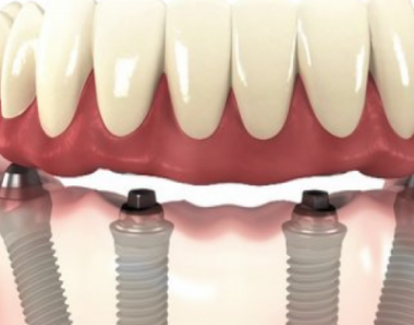 Técnica All on 4 - Prótese sobre implante -Dentista SJC