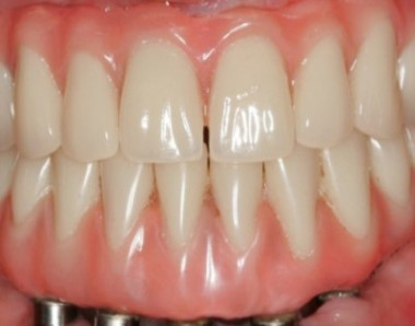 TRATAMENTO COM IMPLANTES PARA USUÁRIOS DE DENTADURA