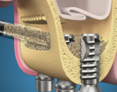 Enxerto de Osso - Implante dentário em casos com pouco osso.