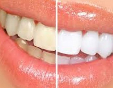 TUDO QUE VOCÊ PRECISA SABER SOBRE O CLAREAMENTO DENTAL.