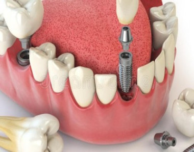 TUDO QUE VOCÊ PRECISA SABER SOBRE OS IMPLANTES DENTÁRIOS.